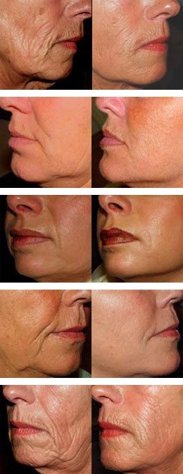 Sculptra behandling af ansigt, kollage med 5 før/efter
