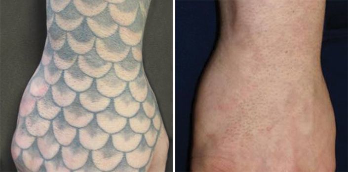Tatoveringsfjernelse på hånd, før og efter behandling