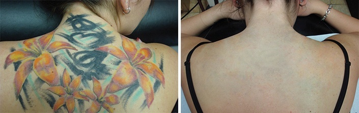 Duplikering Indeholde Overhale Risici ved fjernelse af tatoveringer | klinik DermoCosmetic