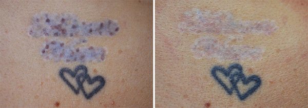 Gammel tatovering forsøgt fjernet med mælkesyre, før og efter behandling med Pico laser