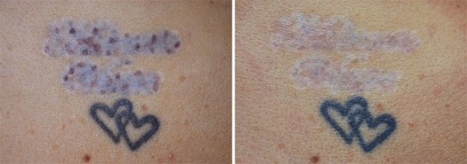 Gammel tatovering forsøgt fjernet med mælkesyre, før og efter behandling med Pico laser
