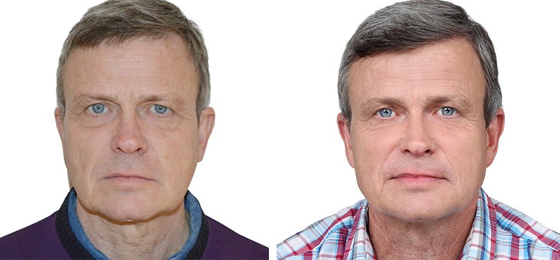 Jørgen Licht før og efter Dermaroller og Restylane behandling