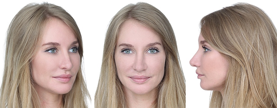 Kvinde 28 år, ansigt efter behandling, 3 vinkler