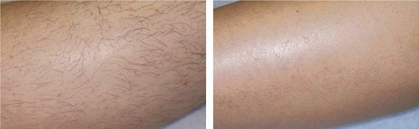 Hårfjerning på ben, før/efter permanent hårfjerning