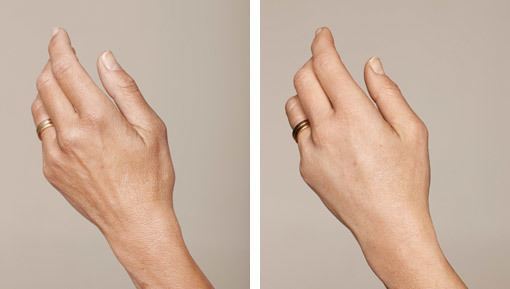 Behandling af solskadet hud på hænder med IPL og ikke-permanente fillere, før/efter