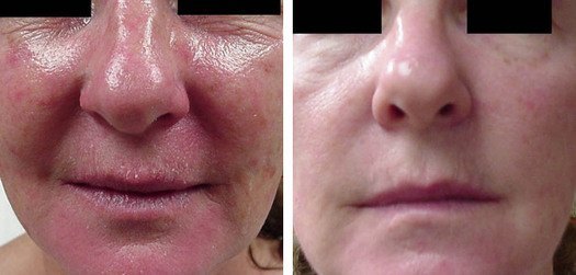 Rosacea behandling ansigt, før og efter