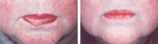 Rosacea behandling mundomgivelser, før og efter