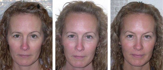 Kvindeansigt før, under og efter behandling