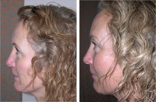 Ansigtsprofil før/efter behandling med Sculptra