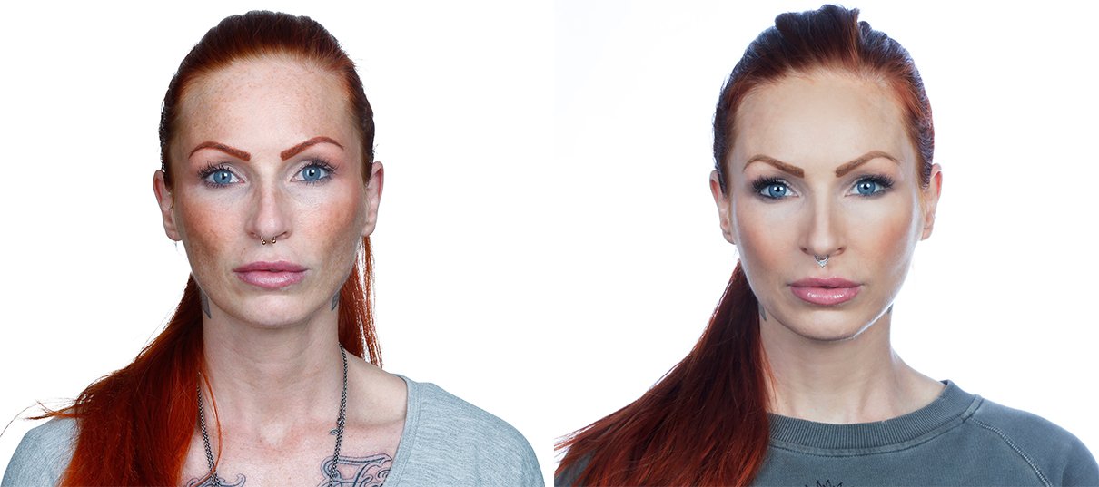Anne Lindfjeld, før og efter behandlingsforløb, forfra