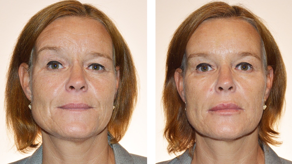Kvindeansigt før og efter Botox behandling