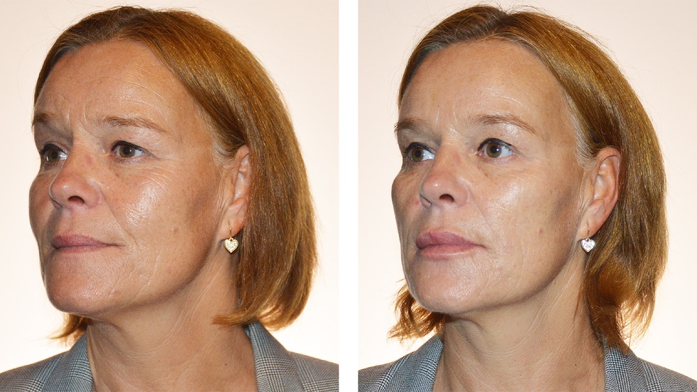 Kvindeansigt før og efter Botox behandling