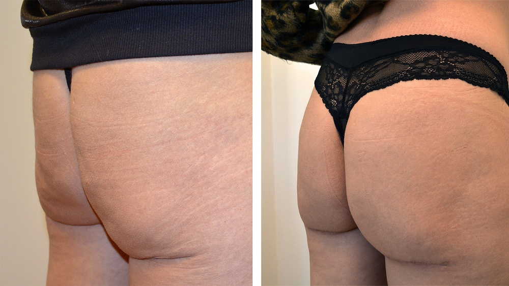 Butt-Lift før og efter 3. behandling