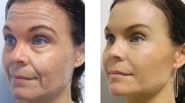 Restylane og Botox behandling - før og efter