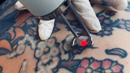 Tatovering fjernes med laser