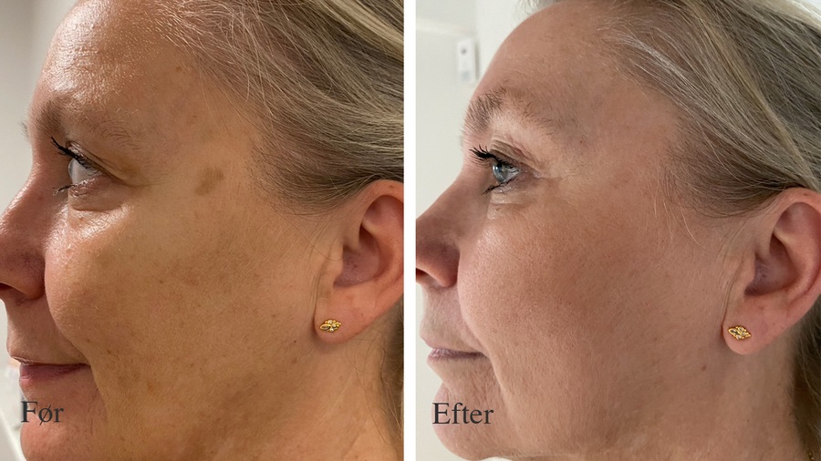 Kvindeansigt før og efter behandling af pigmentpletter