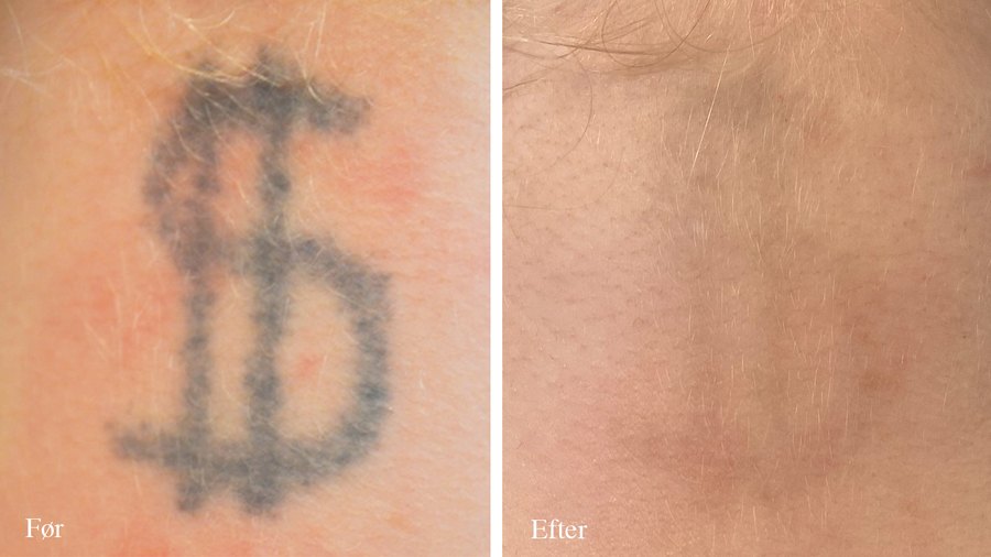 Dollartegn tatoveringsfjernelse før og efter