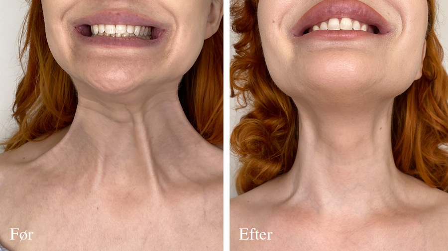 Halsområde før og efter behandling