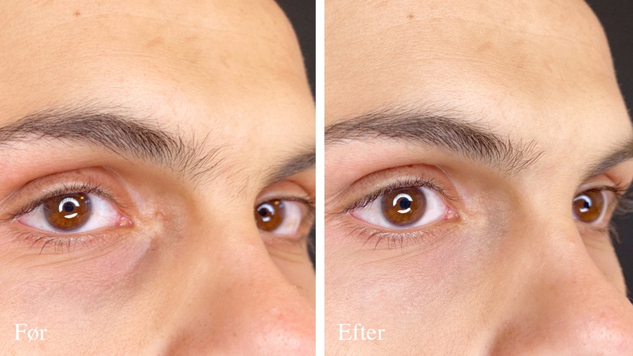 Eyelight før og efter mandeansigt