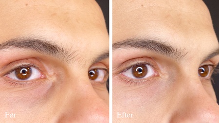 Eyelight før og efter mandeansigt