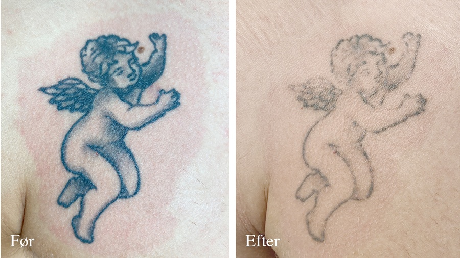 Tatoveringsfjernelse før og efter
