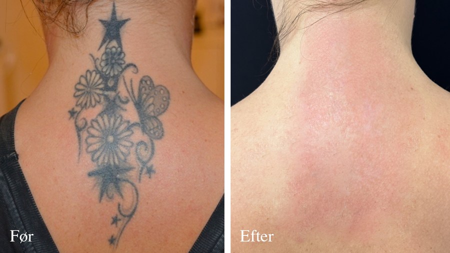 Nakke med tatovering før og efter behandling
