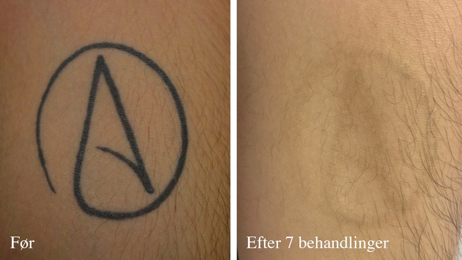 Tatovering før og efter behandling